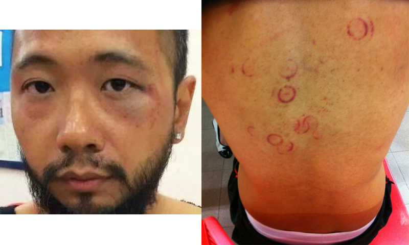 Ken Tsang displays his injuries after being beaten by Hong Kong police.  