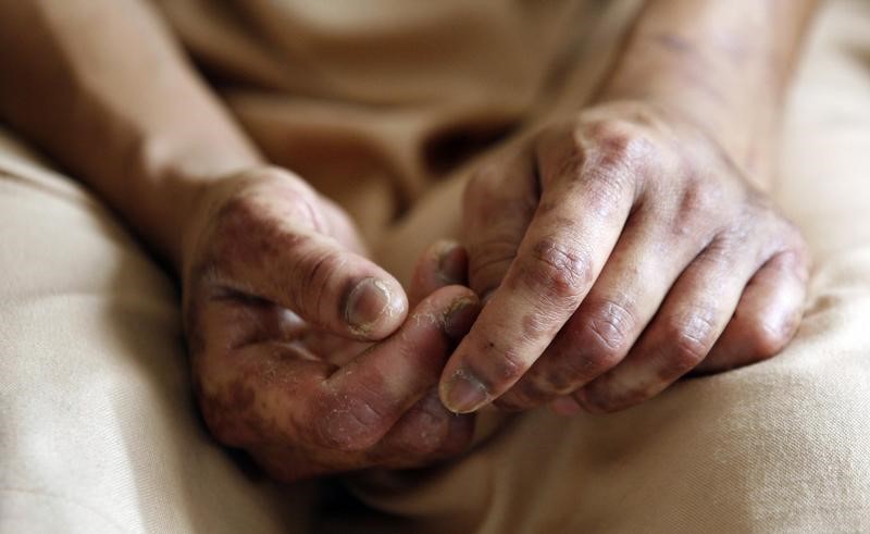 The hands of an Indonesian maid working in Malaysia, Sri Lestari Wagiyo, 19, of East Java, are seen as she talks about her experience of being beaten by her Malaysian employer, in a shelter at the Indonesian embassy in Kuala Lumpur November 5, 2009. REUTERS/Bazuki Muhammad