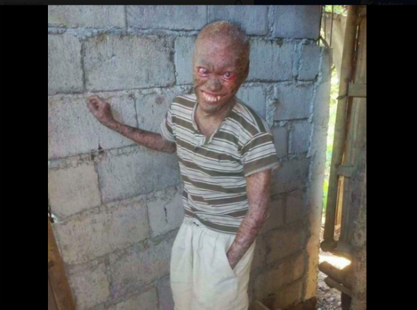 Story Of Cursed Man With Rare Skin Condition Goes Viral On Social Media Coconuts Manila