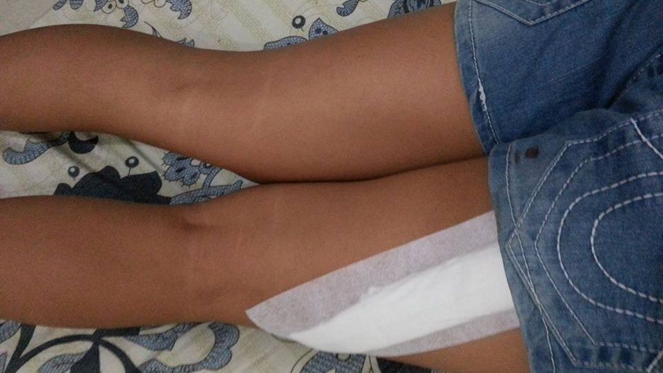 This isn’t the first time we’ve heard of thigh slashing in Bali. This photo went viral after it was posted in December 2015 by another woman who fell victim to a similar assault. Photo via Facebook