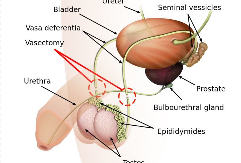 Vasectomy diagram. Source: Wikimedia Commons
