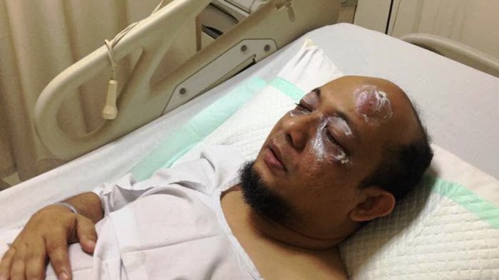 Photo of KPK senior investigator Novel Baswedan in the hospital after his acid attack on April 11, 2017.