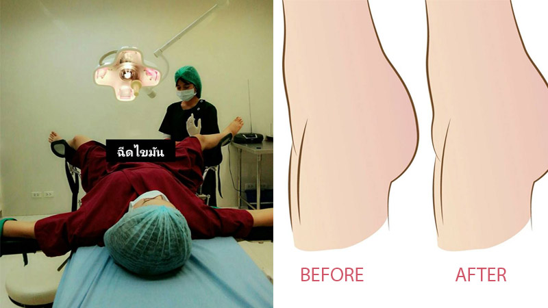 An employee at Lelux Hospital, in Nonthaburi, posted before and after illustrations of the fat injection, along with a photo of a patient lying on the surgical bed in position for surgery on Facebook, Oct. 3, 2017. The post went viral and was shared more than 13,000 times. Photos: Atittayapa Photiya/ Facebook