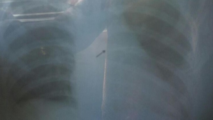 An X-ray showing a needle lodged in Anisa’s respiratory tract.