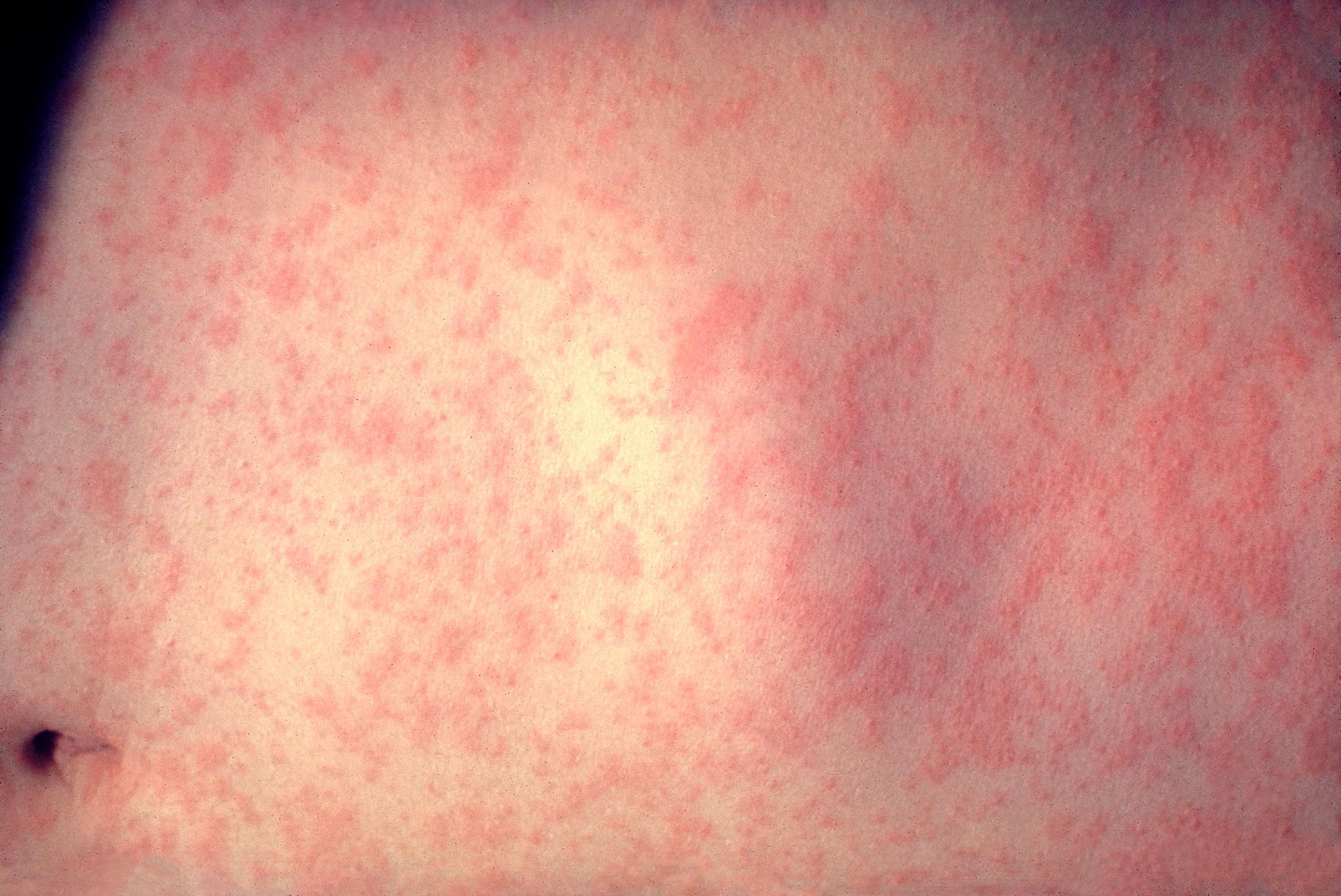Skin with measles. PHOTO: CDC/Dr. Heinz F. Eichenwald via Wikipedia