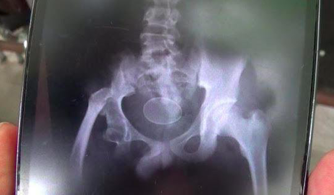 An X-Ray showing an egg-shaped object nesting in a teenager’s rectum in Indonesia. Photo: Twitter