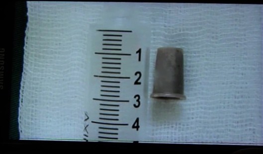 A small plastic whistle extracted from the respiratory tract of an Indonesian boy. Photo: Video screengrab
