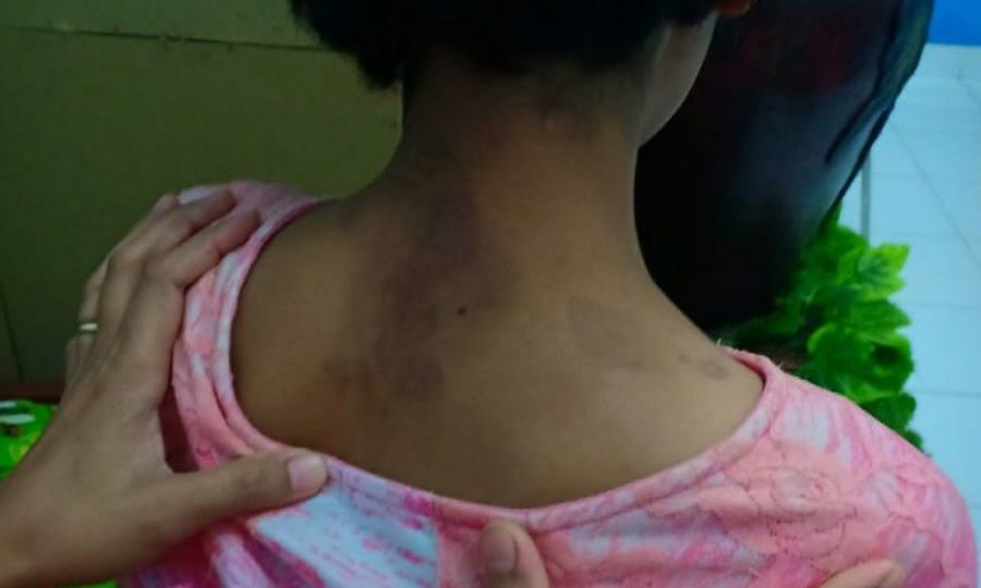 File photo showing bruises on one of the victims’ body. Photo: Yuni Rusmini / Facebook