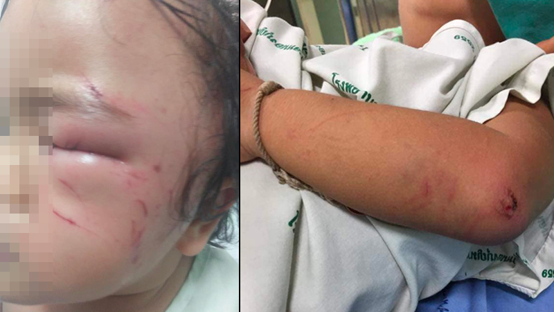 The injured 13-month-old child at Nong Bunmak Hospital. Photo: Cha Gu Ra / Facebook 
