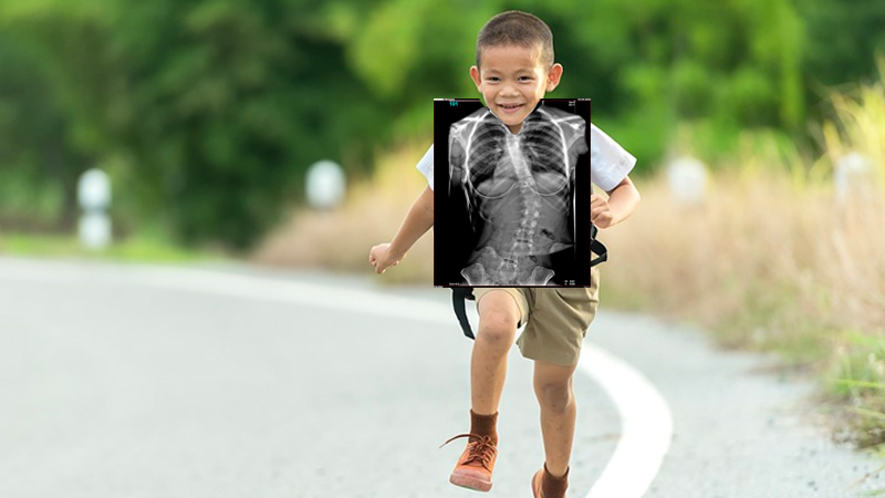 A Thai schoolboy with an ominous X-ray forecasting a stunted future. Original image: Sasin Tipchai
