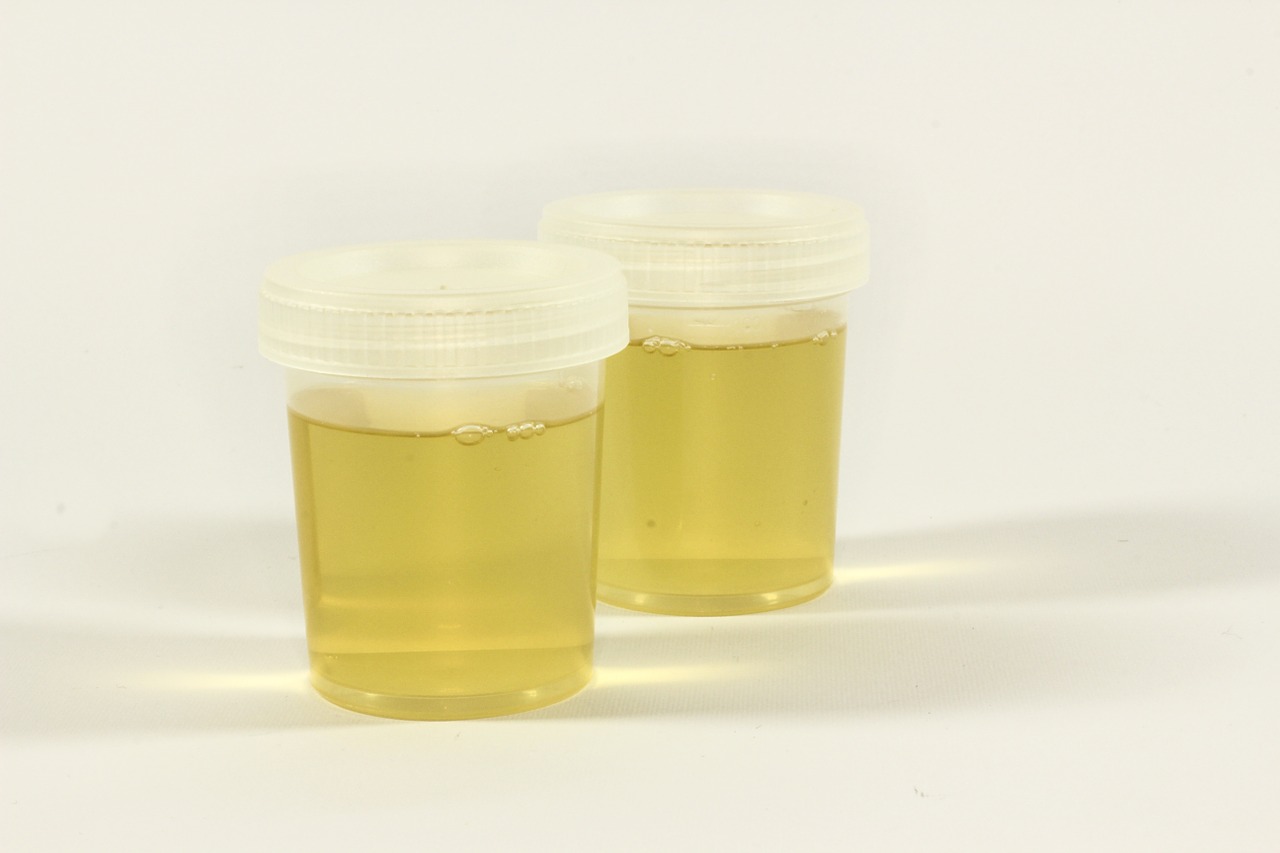 File photo of urine sample. Image: Ewa Urban