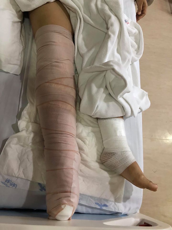 Malini Wirasuchart's leg after 16 days in the hospital. Photo: Ester Chill / Facebook 