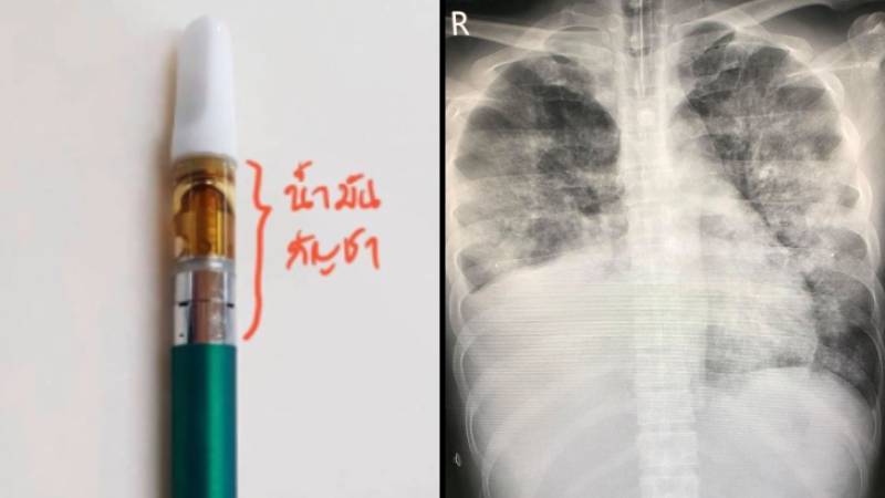 The THC oil vape purchased by the patient from the United States, at left. At right, an X-ray of his lungs found pneumonia after vaping. Photo: Manoon Leechawengwongs / Facebook