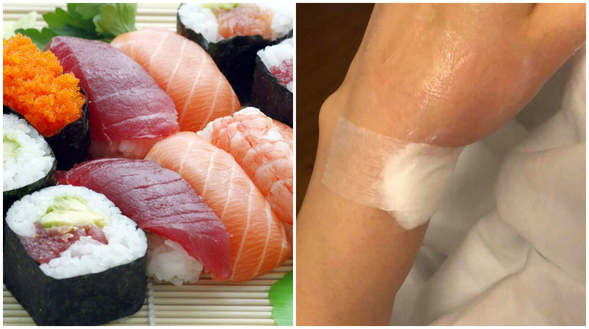 File photo of sushi assortment, at left, Singapore woman’s wrist after an injection. Photo: Pixabay, Marc Wong/Facebook