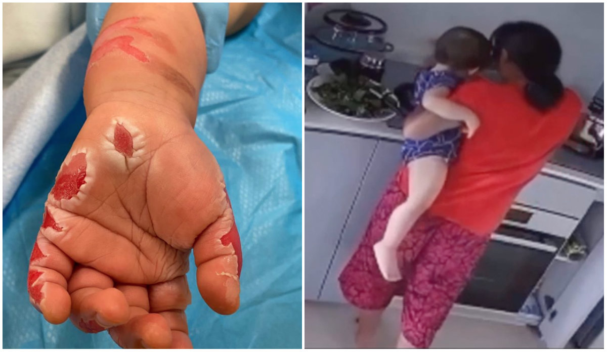 Photo of purported burns on toddler’s hand, at left, the alleged maid caught on video dipping toddler’s hand in hot pot. Images: Amy Low Mei Liang/Facebook