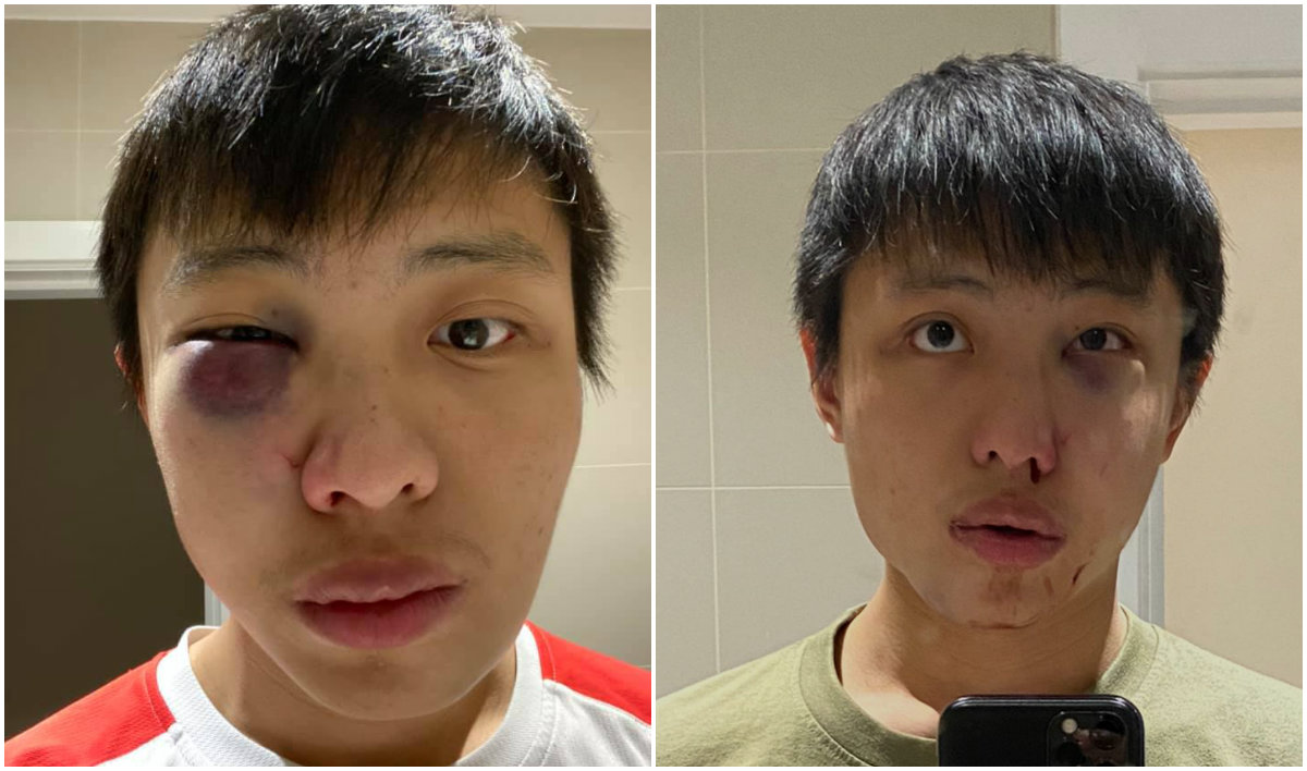 Jonathan Mak said he captured a selfie a day after the said attack (left) and immediately after it. Photos: Jonathan Mak/Facebook