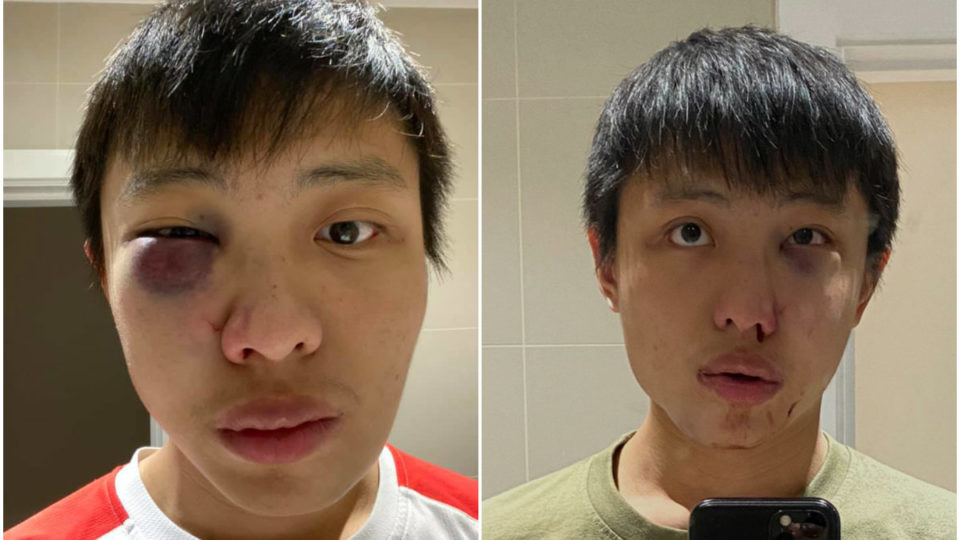 Jonathan Mak said he captured a selfie a day after the said attack (left) and immediately after it. Photos: Jonathan Mak/Facebook