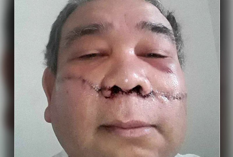 Filipino Noel Quintana was attacked by a man holding a box cutter while riding the New York subway. 