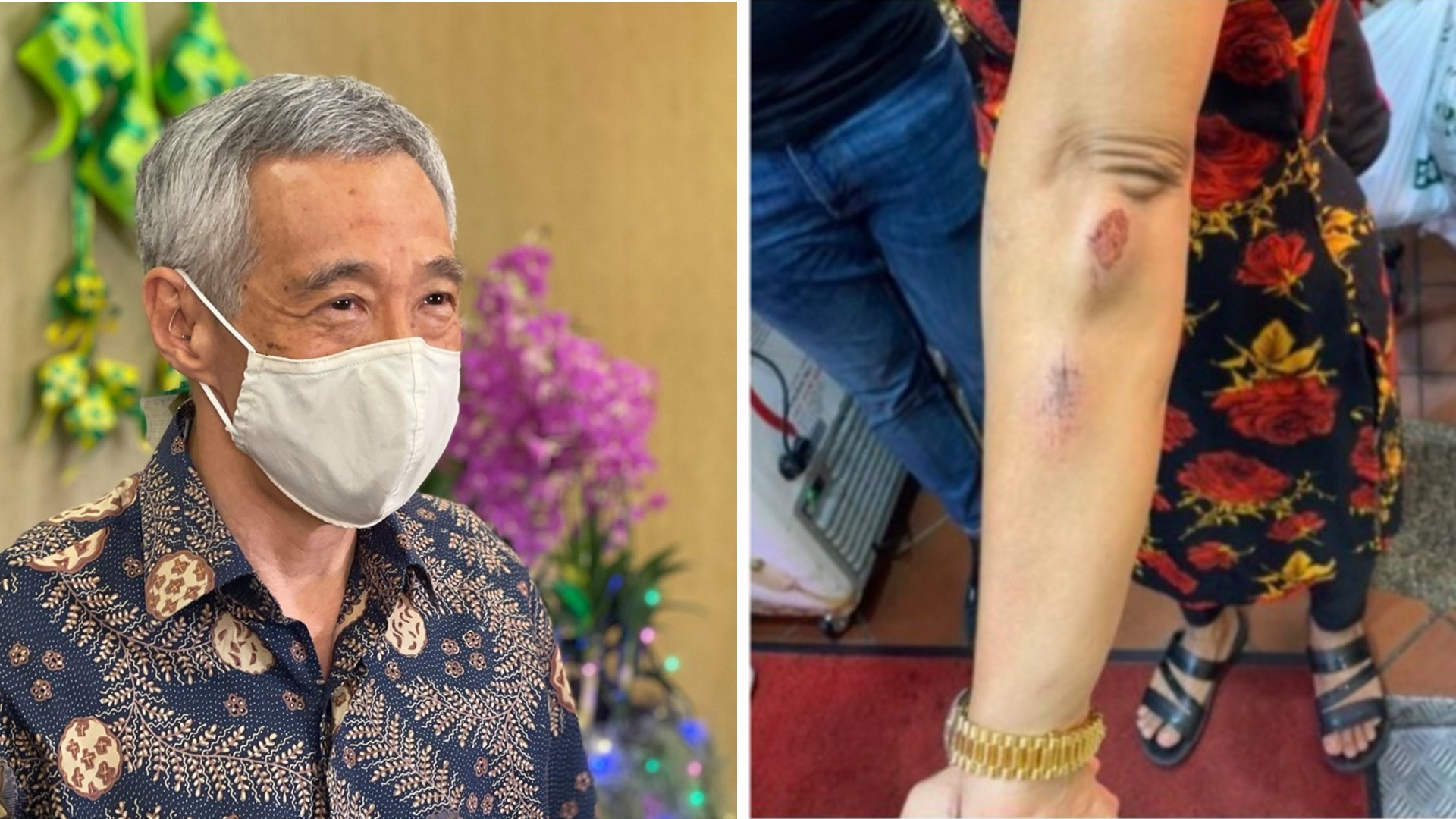 At left, Lee Hsien Loong in an April photo, wounds sustained by a woman attacked in broad daylight on Friday, at right. Photo: Lee Hsien Loong/Facebook, @Parrvyy/Instagram