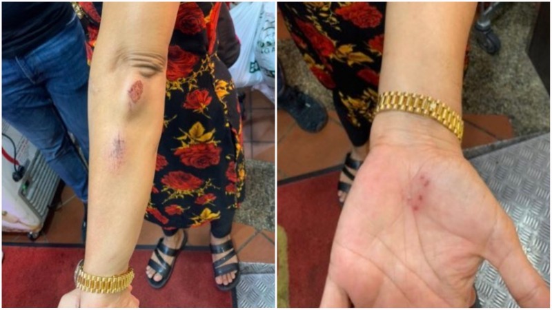 The victim’s injuries on her left hand from the Friday attack. Photos: @purrvyy/Instagram
